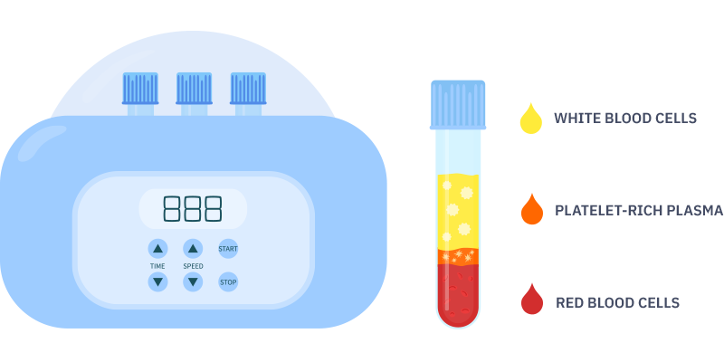 PRP: Separation of Platelets